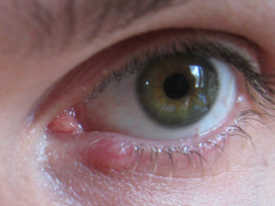 Internal stye: how long does it last? Causes and remedies