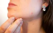 Acne sul viso: i consigli su come curarla