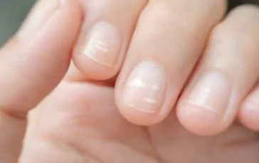 Righe sulle unghie: le cause e come risolvere
